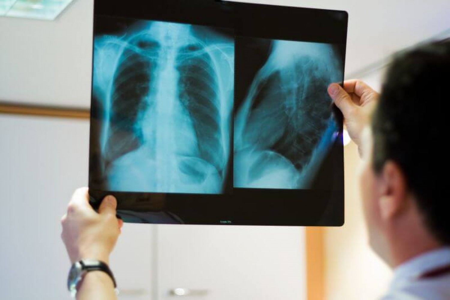 A tüdőgyógyász tanácsa: Mit tegyenek a légúti betegek a koronavírus járvány idején